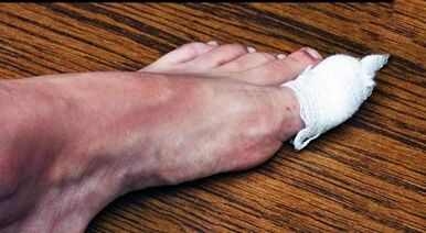 Compresas para tratar o fungo no dedo pulgar da perna