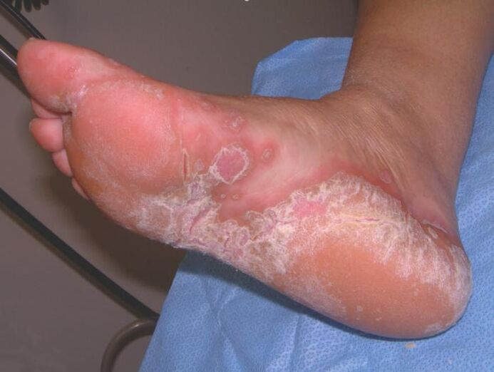 Pé afectado por infección fúngica