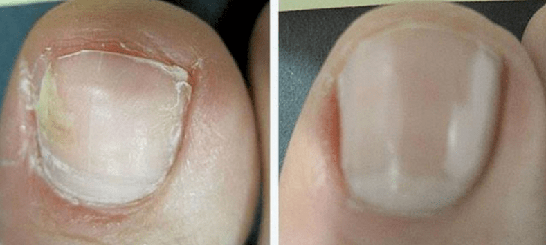 Unhas antes e despois do tratamento de fungos